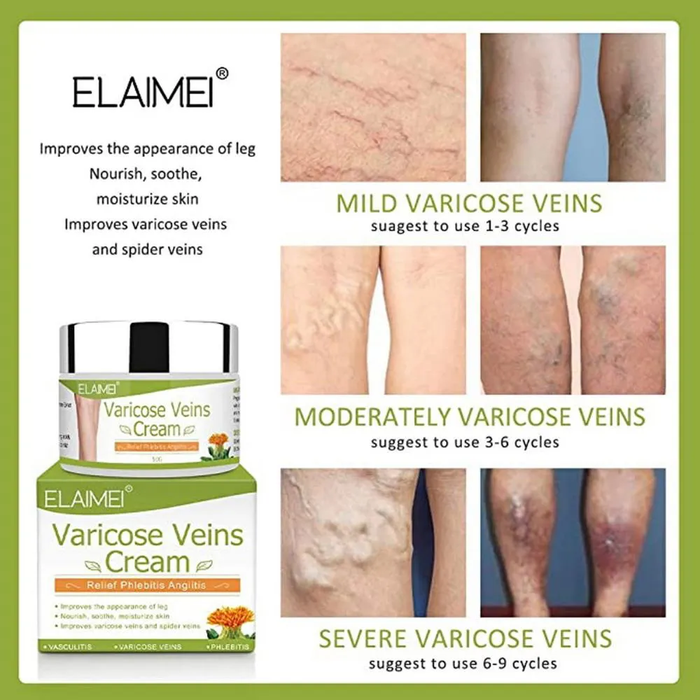 Varicose Veins Repair Cream
