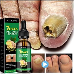 Nail Fungal Fungus Removal Treatment Essence Oil for Foot Care