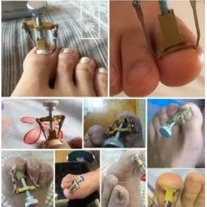Ingrown Nail Foot Correction Tool Pedicure Toenail Fixer Foot Nail Care pedicure Tool